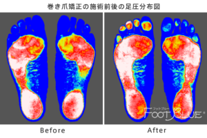 巻き爪矯正後の足底分圧の変化