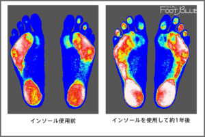 インソールの使用前後のフットプリント